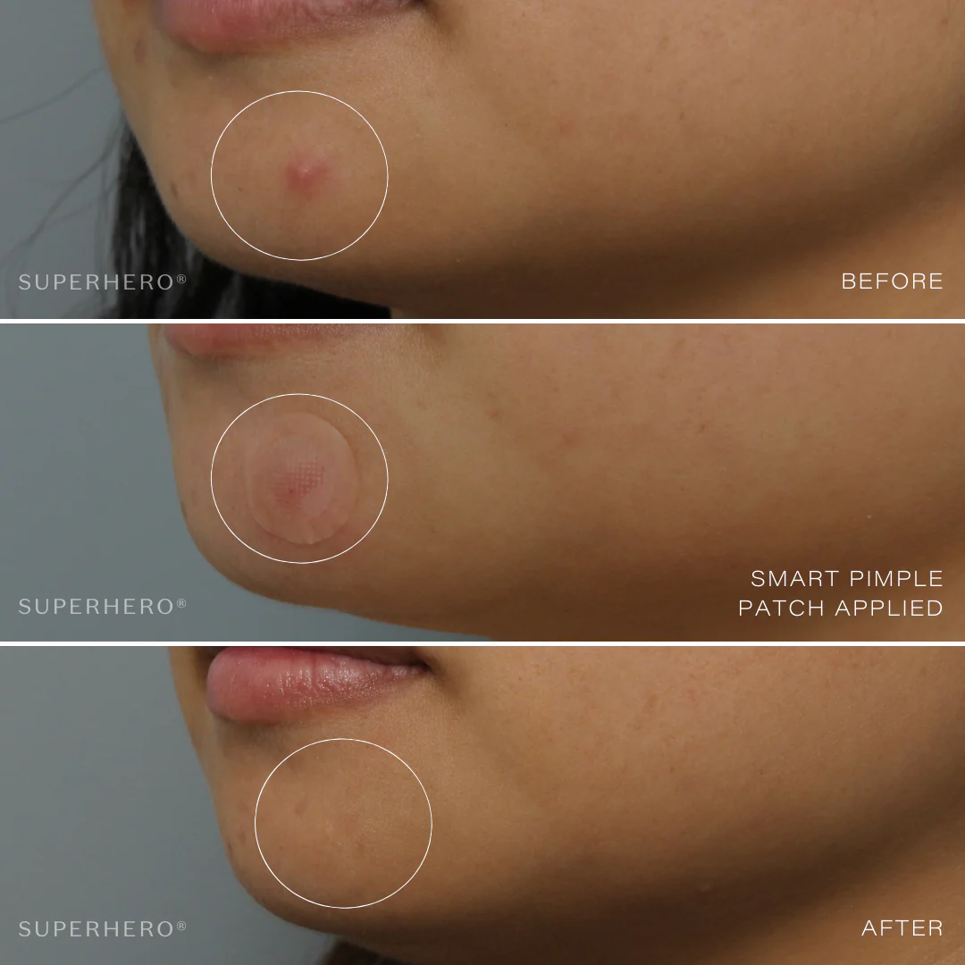 cure-aid-hydrocolloid-spot